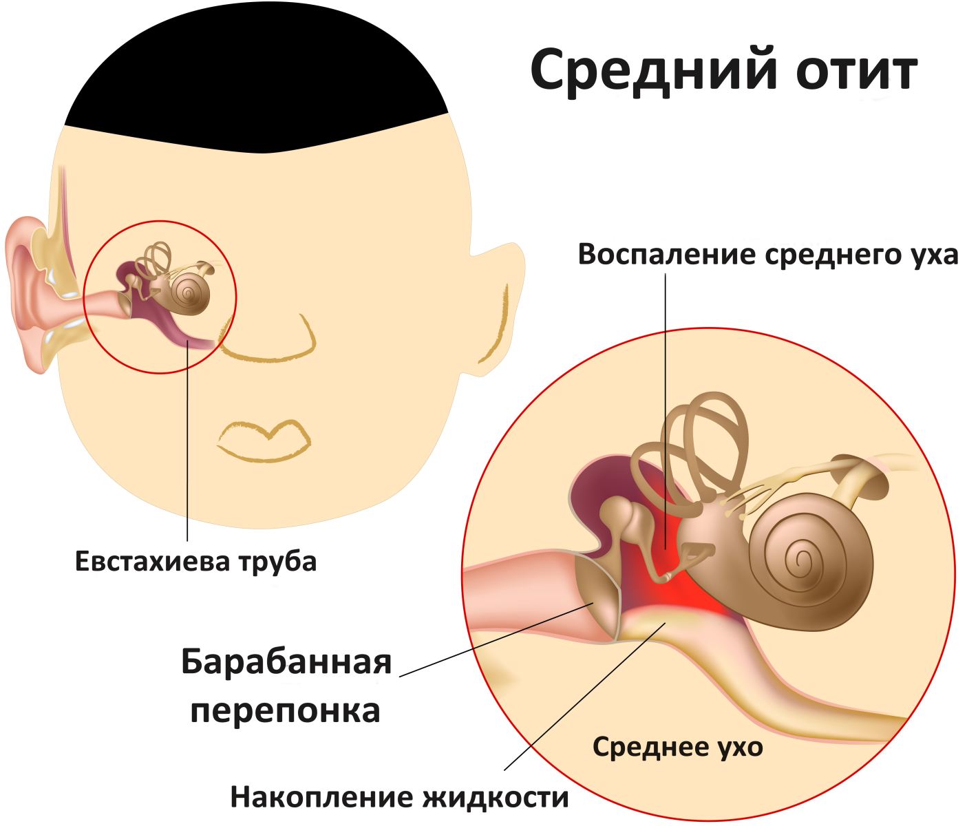 Почему болит ухо? Заболевания ушей и их симптомы