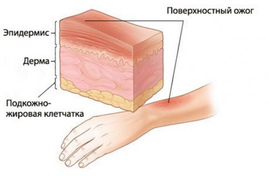 Помощь при ожогах всех степеней thumbnail