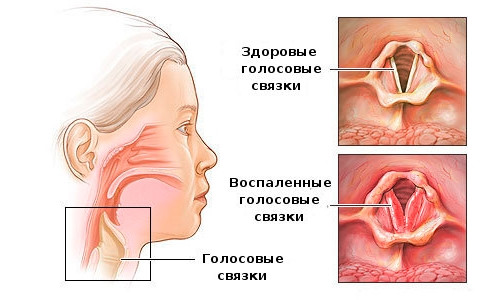 насморк аллергия