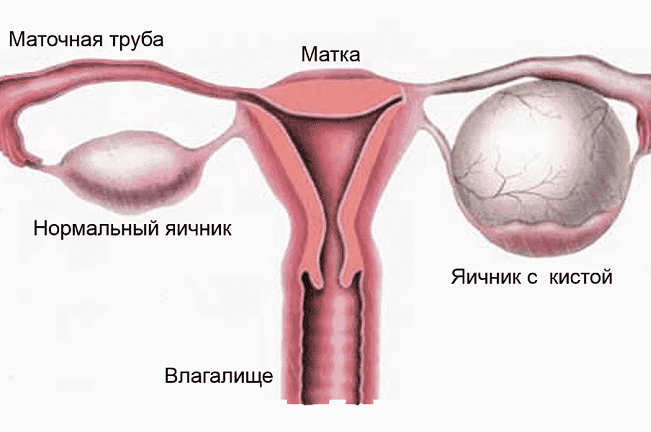 Нормальный яичник яичник с кистой