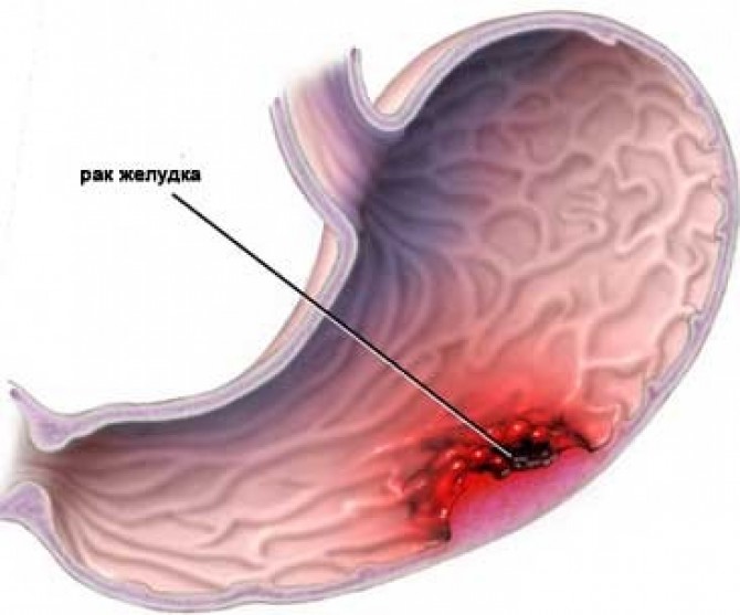 Как пишется диагноз при раке желудка thumbnail