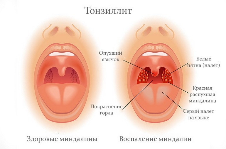 Острый тонзиллит