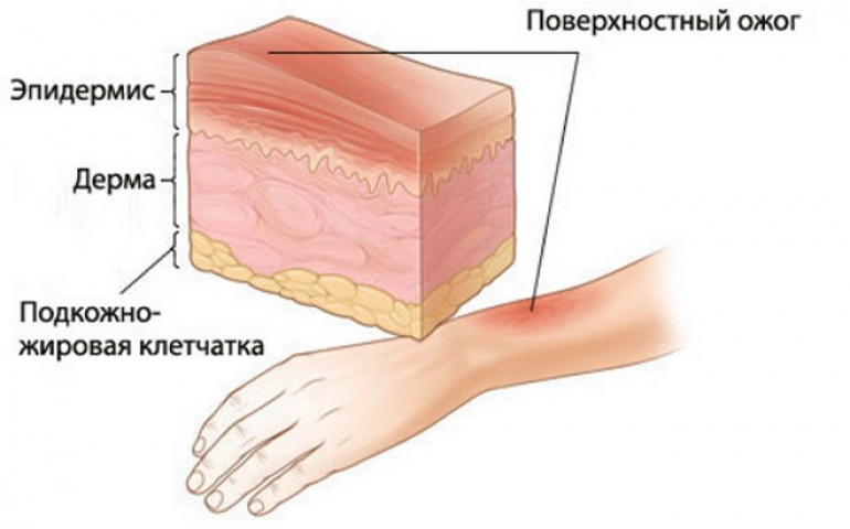 Степени ожогов: первая помощь в зависимости от тяжести повреждений